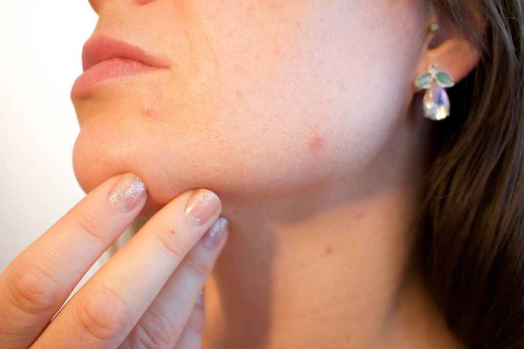 comment-faire partir acne