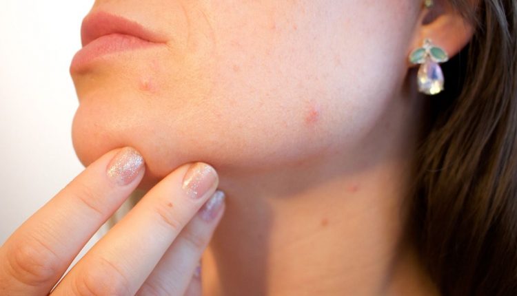 comment-faire partir acne