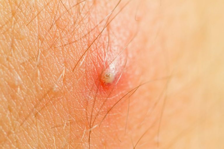 Traitements au naturel pour combattre les furoncles