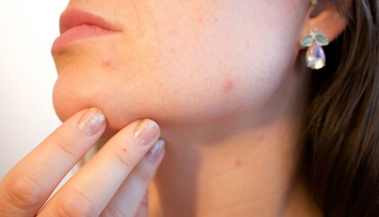 routine-anti-acne